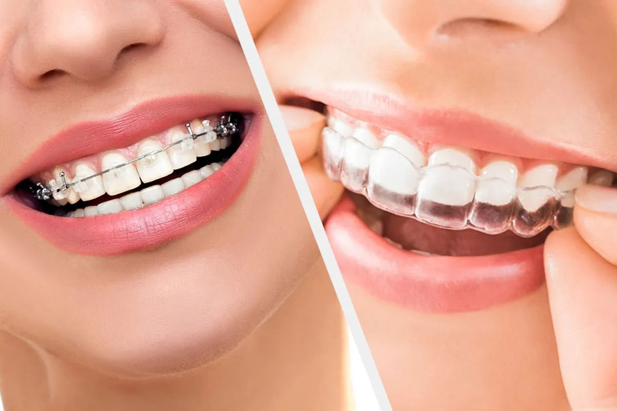 Is it cheaper to get braces or Invisalign?