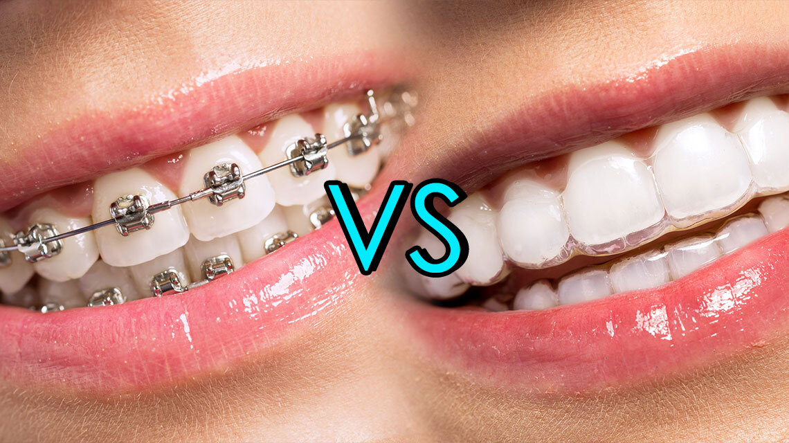 What is faster braces or Invisalign?